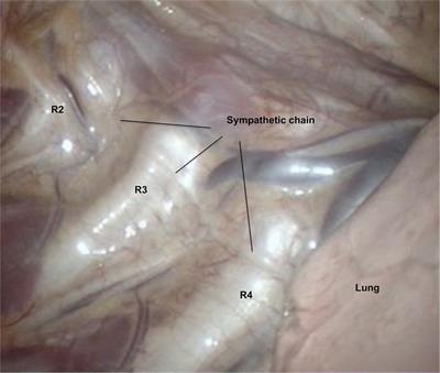 Changes in electrodermal activity following sympathicotomy in hyperhidrosis patients